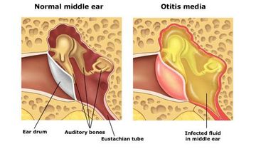 Ear Infections