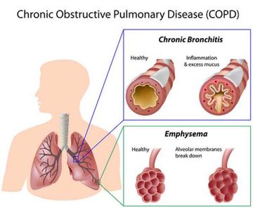COPD
