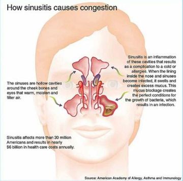 Sinusitis blocked nose discount