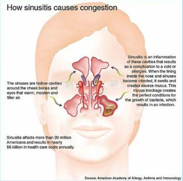 Sinusitis