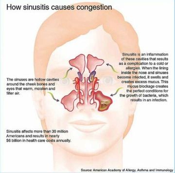 Sinusitis